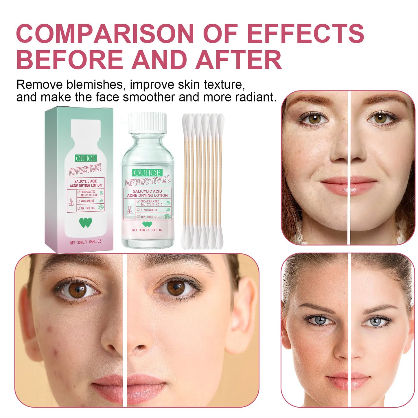 Salicylate Acne Lotion Mild Repair