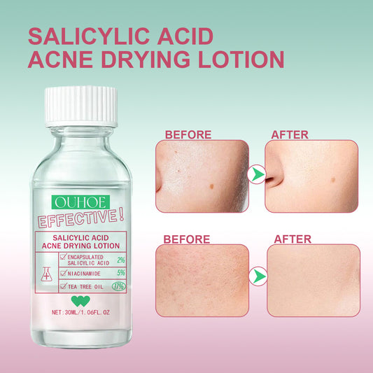 Salicylate Acne Lotion Mild Repair